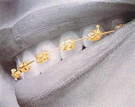 Image result for braces