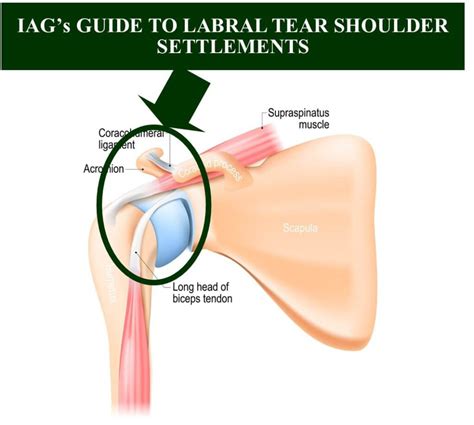 Image result for Shoulder Labral Tear Surgery