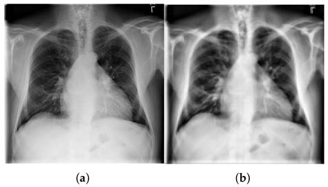 A Comparative Evaluation of Meta-Learning Models for Few-Shot Chest X ...
