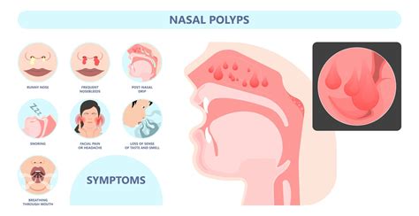 Nasal Polyps & Surgery | Florida Sinus & Snoring Specialists