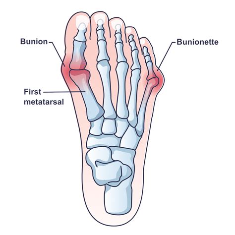 Bunion Correction - Somastruct