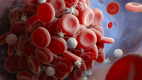 Apixaban reduziert rezidivierende Thrombosen bei Krebspatienten ...