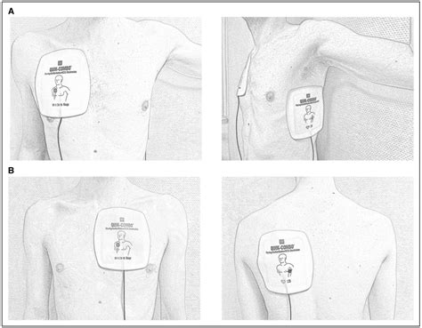 Pad Placement For Defibrillation at Brittany Moya blog