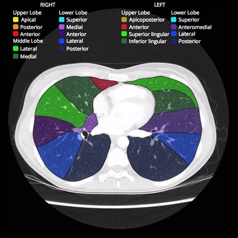 Lung Segments Ct Anatomy Right Lower Lobe Segmentation: CPAM In Extra