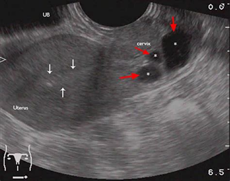 Nabothian Cyst Ultrasound