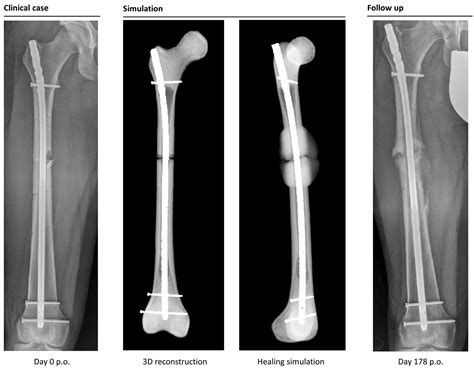 Computer-Based Mechanobiological Fracture Healing Model Predicts Non-Union of Surgically Treated ...