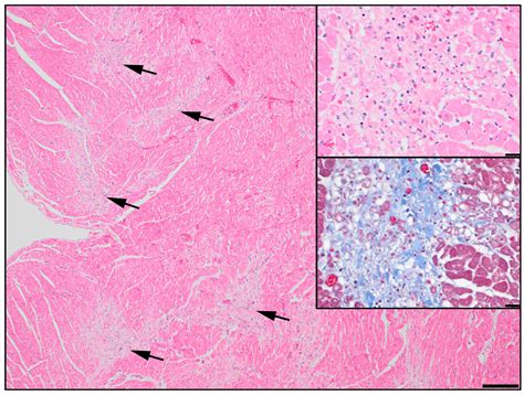 An ABCC9 Missense Variant Is Associated with Sudden Cardiac Death and ...
