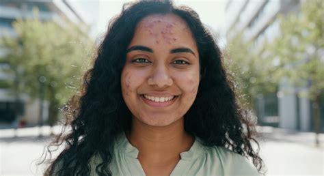 Adult Acne: Why Acne Is Harder to Treat and Its Best Solution! – Meethi ...