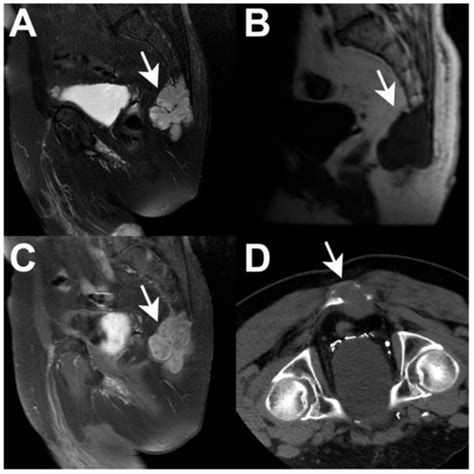 JCM | Special Issue : Bone and Soft Tissue Sarcomas: A “Big” Family of ...