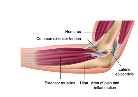 What Happens If Tennis Elbow Remain Untreated