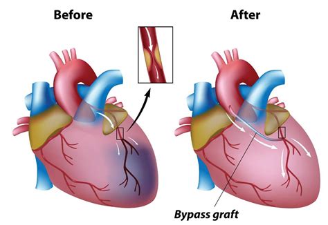 Coronary Artery Bypass Graft Surgery (CABG) - Cardiovascular ...