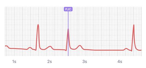 What Heart Palpitations and Irregular Heartbeats Look Like on Your ...