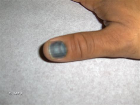 Bleeding Under Nail-Subungual Hematoma- Walk In Clinic Orlando | Urgent ...
