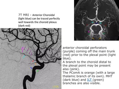 Anterior Choroidal Artery.pptx