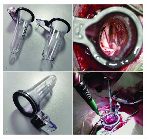 Image result for Retractor Assembly Exploded View