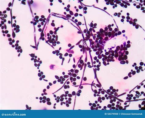 yeast cells in urine