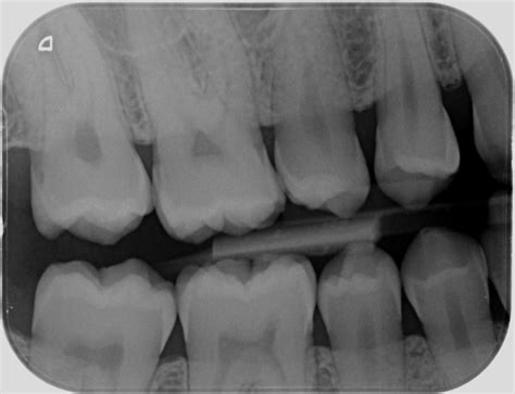 Types of Dental Radiographs and their Uses - dentalnotebook