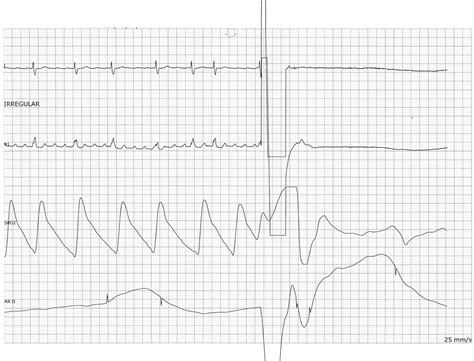 P atrial flutter icd 10 - lomiglo