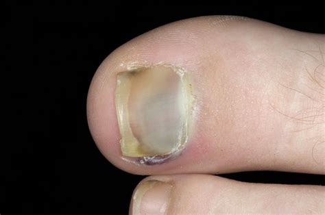 Image:Subungual Hematoma (Toenail)-Merck Manual Professional Edition