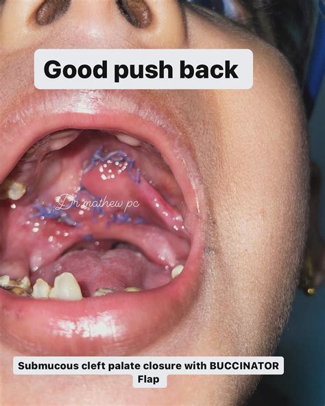 Submucous Cleft Palate