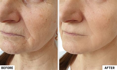 HIFU Facial: Advanced Skin Tightening Treatment| Kaya