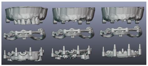 Predictable Full Digital Workflow Using Stackable Surgical Templates ...