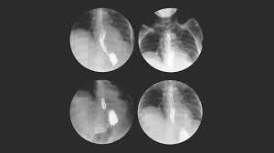 Comprehensive Guide to Barium Swallow Examination
