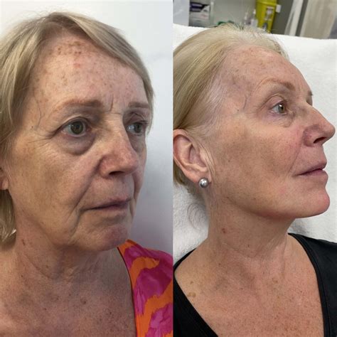 Image result for Thread Removal