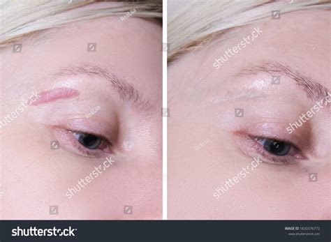 Eyebrow Piercing Scar Removal