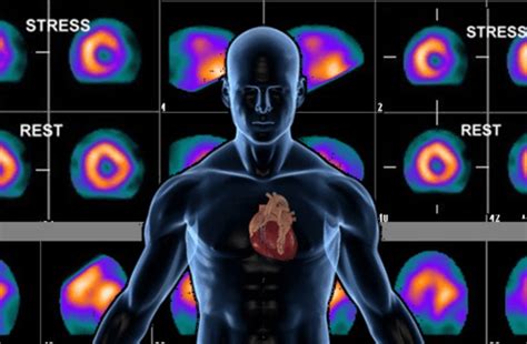 Nuclear Stress Tests: Purpose, Procedure, Risks, and Benefits
