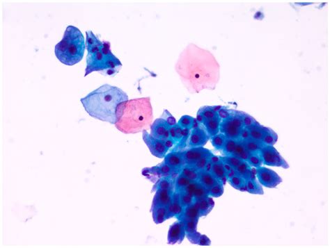 Evaluation of a Novel Fixative Solution for Liquid-Based Cytology in ...