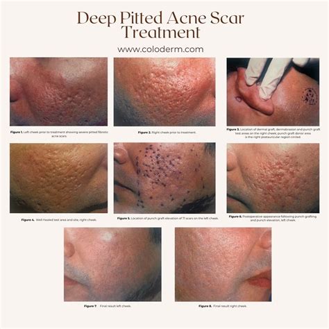 Pitted Acne Scars Multiple Discrete Pitted Scars Over The Face