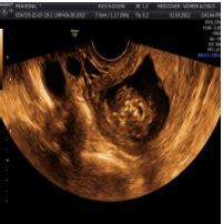 Success Story of Anencephaly Case - Medicover Hospital