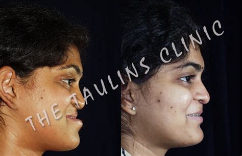 Cleft Lip and Palate surgery Bangalore, INDIA:::