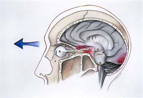 Concussion Eye Pain Behind
