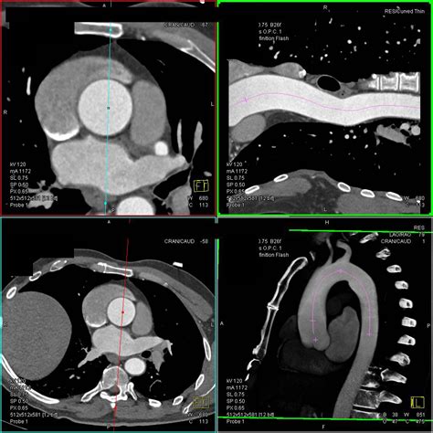 Mildly Dilated Aortic Root and Ascending Aorta - Vascular Radiology Case Studies - CTisus CT ...