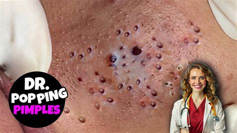 Image result for Exploding Pimples 2017