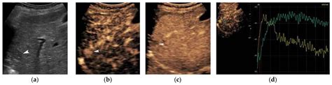 Current Imaging Diagnosis of Hepatocellular Carcinoma