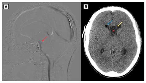 Symptomatic Cavum Septum Pellucidum and Vergae Cyst: A Case Report