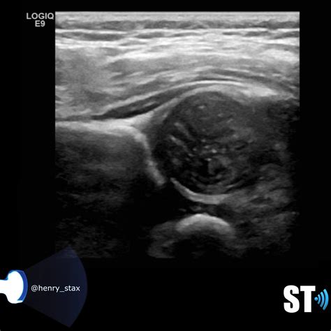 Neonatal Hip Ultrasound – Sonographic Tendencies