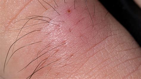 Image result for Removing Carbuncle