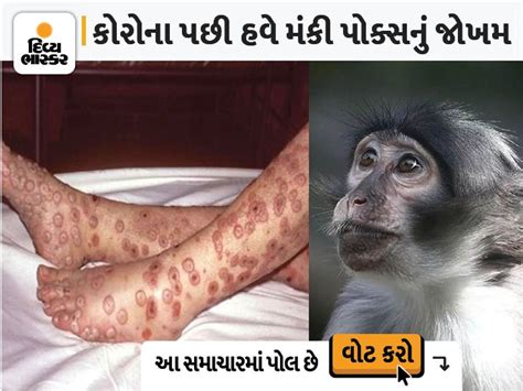 The first case of Monkey Pox in America was also found in Spain ...