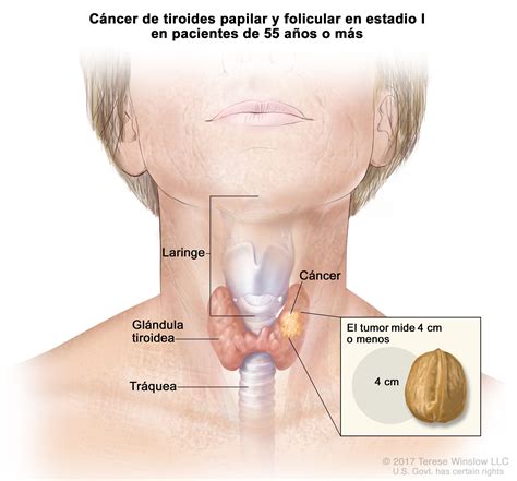 Cáncer de tiroides: Tipos, Síntomas, Causas y Tratamiento | Guía de salud | Vidaliax