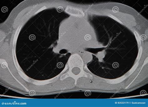 Lung CT stock image. Image of tomography, scan, imaging - 83533179