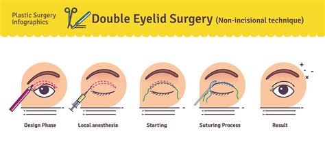 Double Eyelid Surgery in Korea - Seoul Guide Medical