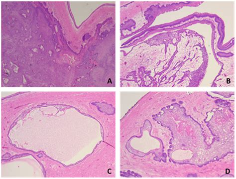 Ameloblastoma of the Mandible in a 16-Year-Old Female—Case Report