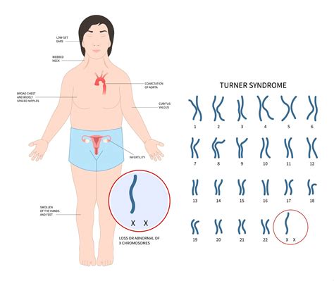 Xy Chromosome Disorders Genetics Information | Mount Sinai New York
