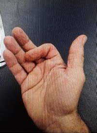 Image result for Finger Dislocation Treatment