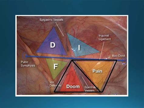 Laparoscopic Anatomy of the Inguinal Region | PPTX