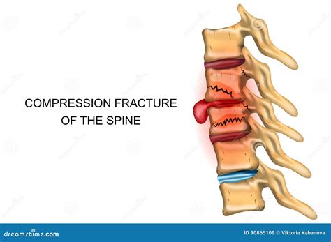 Spinal Fracture Icon, Outline Style Vector Illustration | CartoonDealer.com #171187994